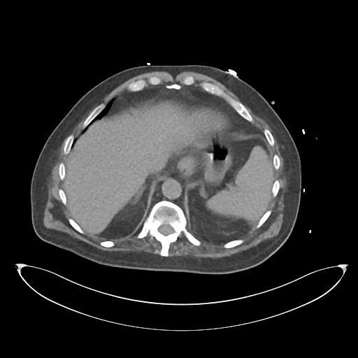 File:Obstructive pyelonephritis (Radiopaedia 46411-50844 Axial non-contrast 16).png