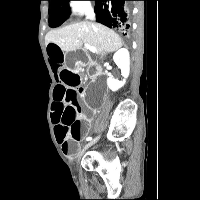 Obturator hernia causing small bowel obstruction (Radiopaedia 65522-74612 C 66).jpg