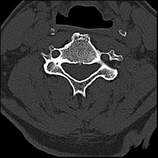 Occipital condyle fracture (type 1) (Radiopaedia 87670-104084 Axial bone window 49).jpg