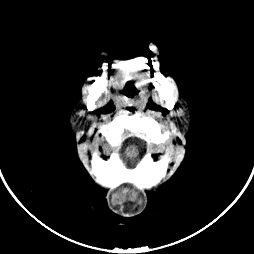 Occipital encephalocele (Radiopaedia 87339-103636 Axial non-contrast 13).jpg