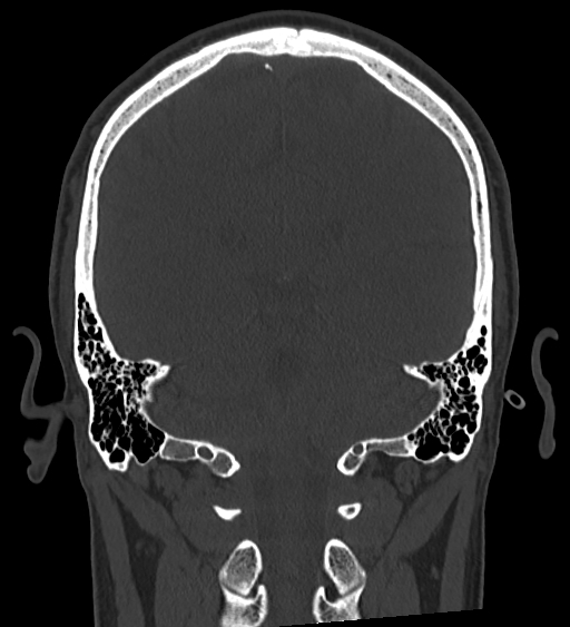 Occipital spur and Currarino type A atlas anomaly (Radiopaedia 87027-103285 Coronal bone window 100).jpg