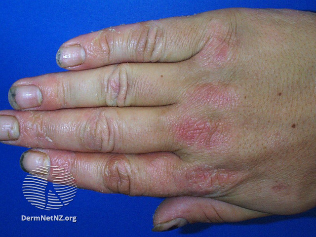 File:(DermNet NZ dermatitis-hand-dermatitis-2852).jpg