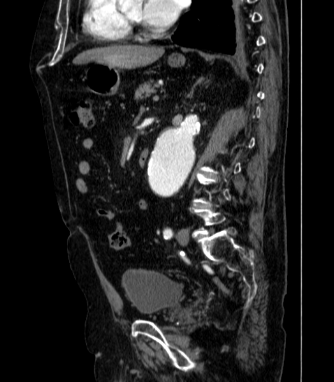 Abdominal aortic aneurysm (Radiopaedia 25855-26001 Sagittal C+ arterial phase 37).jpg
