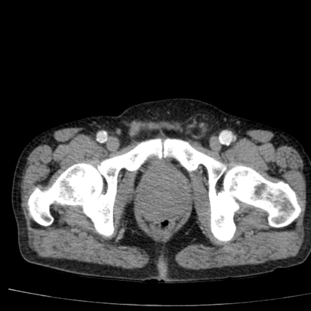 Abdominal aortic aneurysm (Radiopaedia 29248-29660 Axial C+ arterial phase 91).jpg