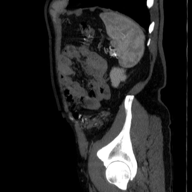 Abdominal aortic aneurysm (Radiopaedia 29248-29660 Sagittal C+ arterial phase 46).jpg