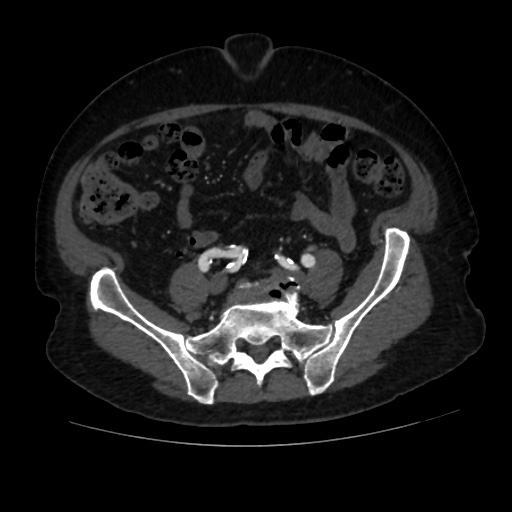 File:Abdominal aortic aneurysm (Radiopaedia 57318-64259 Axial C+ arterial phase 53).jpg