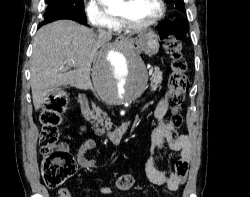 Abdominal aortic aneurysm (Radiopaedia 67117-76452 Coronal C+ arterial phase 35).jpg