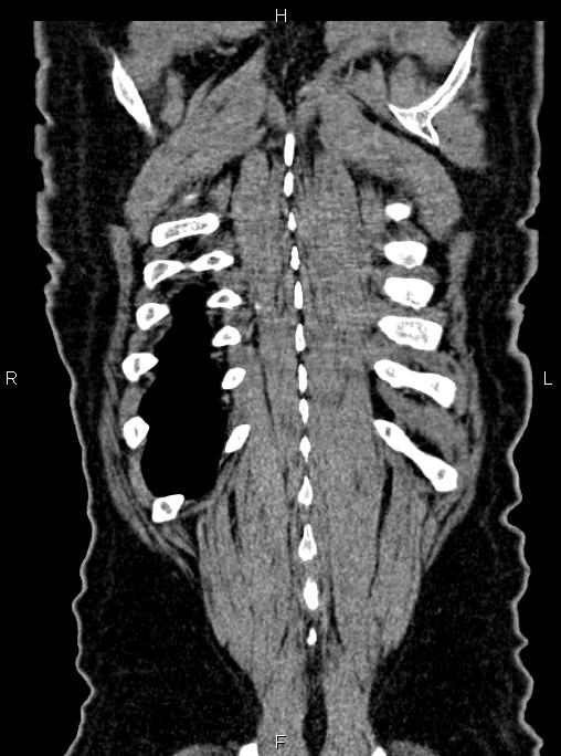 Abdominal aortic aneurysm (Radiopaedia 83094-97462 Coronal renal cortical phase 84).jpg