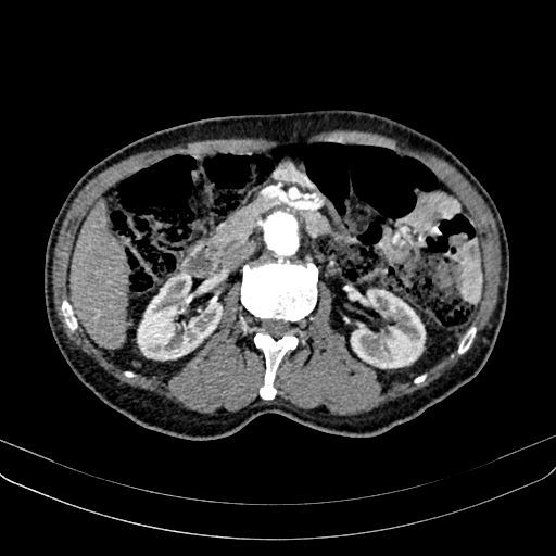 Abdominal aortic aneurysm (Radiopaedia 83581-98689 Axial C+ arterial phase 52).jpg