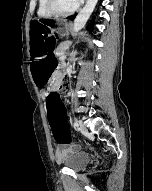 Abdominal aortic aneurysm (Radiopaedia 83581-98689 Sagittal C+ portal venous phase 72).jpg