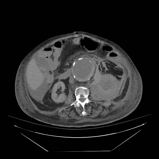 Abdominal aortic aneurysm - impending rupture (Radiopaedia 19233-19247 Axial non-contrast 87).jpg