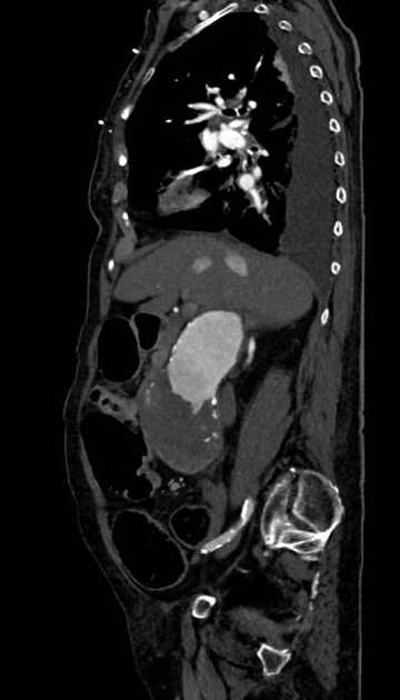 Abdominal aortic aneurysm with thrombus fissuration (Radiopaedia 73192-83919 Sagittal C+ arterial phase 91).jpg