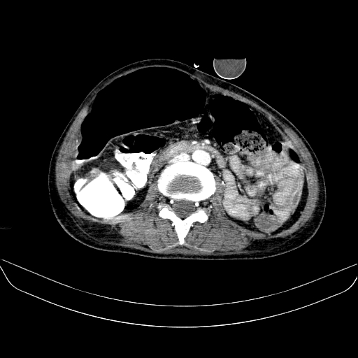 File:Abdominal collection due to previous cecal perforation (Radiopaedia 80831-94320 Axial C+ portal venous phase 107).jpg