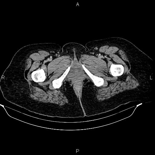 Abdominal lymphoma with sandwich sign (Radiopaedia 84378-99704 Axial C+ portal venous phase 62).jpg