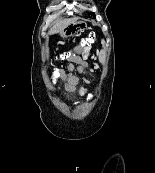 Abdominal lymphoma with sandwich sign (Radiopaedia 84378-99704 Coronal C+ portal venous phase 2).jpg