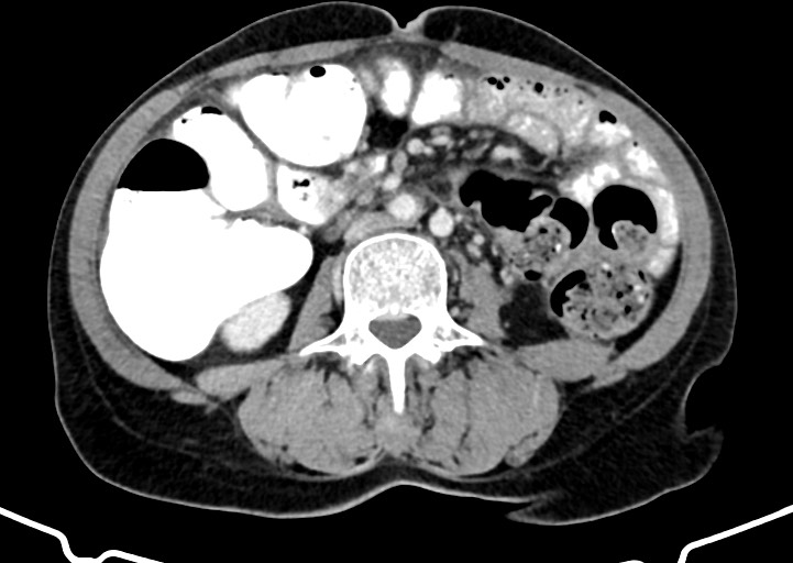 Abdominal wall and retroperitoneal tuberculosis (Radiopaedia 88137-104729 Axial C+ portal venous phase 103).jpg