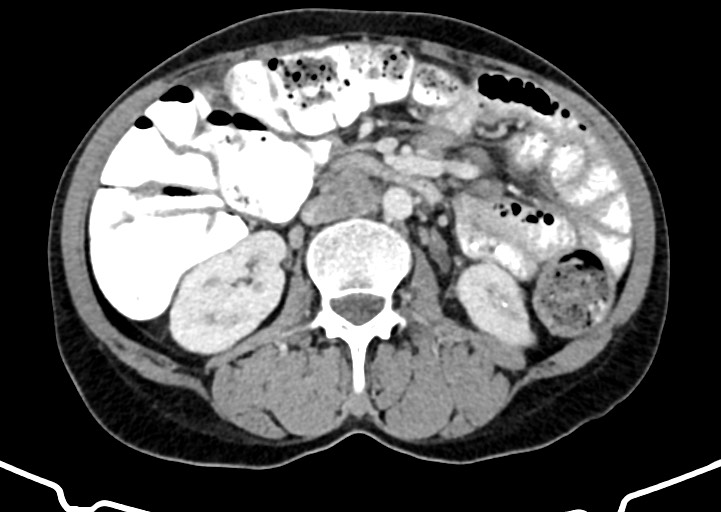 Abdominal wall and retroperitoneal tuberculosis (Radiopaedia 88137-104729 Axial C+ portal venous phase 91).jpg