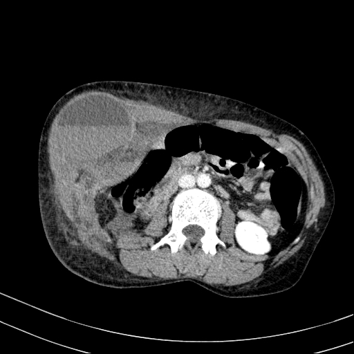 Abdominal wall hematoma with active bleeding (Radiopaedia 83915-99122 Axial contrast-enhanced CT 17).jpg