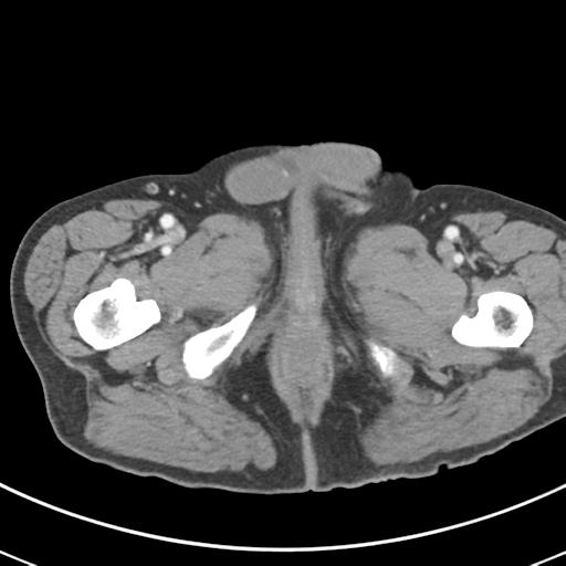 Abdominal wall metastasis from colorectal carcinoma (Radiopaedia 31016-31717 Axial C+ portal venous phase 85).jpg