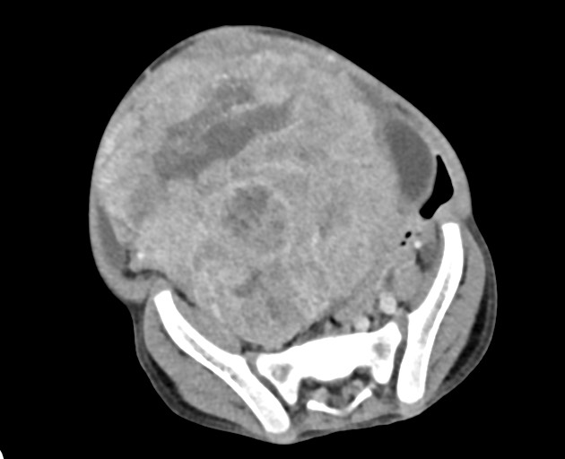 File:Abdominopelvic rhabdomyosarcoma (Radiopaedia 78356-90984 Axial C+ portal venous phase 126).jpg