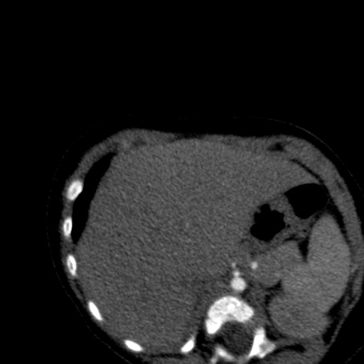 Aberrant left pulmonary artery (pulmonary sling) (Radiopaedia 42323-45435 Axial C+ CTPA 47).jpg