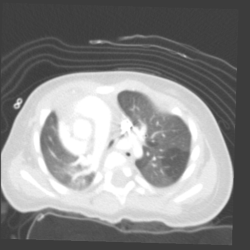 File:Aberrant left pulmonary artery (pulmonary sling) (Radiopaedia 42323-45435 Axial lung window 15).jpg