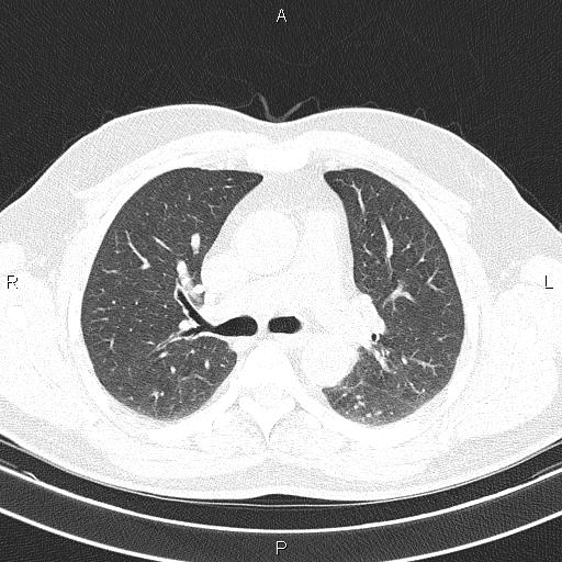 Aberrant right subclavian artery (Radiopaedia 87093-103354 Axial lung window 44).jpg