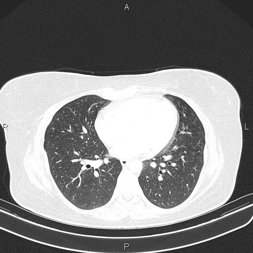 File:Aberrant right subclavian artery (Radiopaedia 87334-103629 Axial lung window 41).jpg