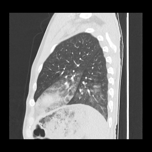 File:Accessory left horizontal fissure with lingular pneumonia (Radiopaedia 53763-59843 Sagittal lung window 53).jpg