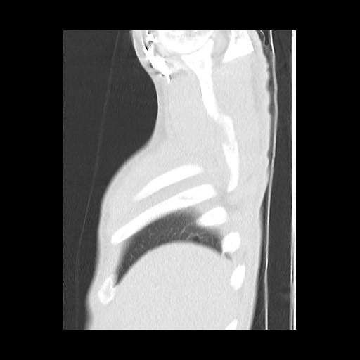 Accessory left horizontal fissure with lingular pneumonia (Radiopaedia 53763-59843 Sagittal lung window 9).jpg