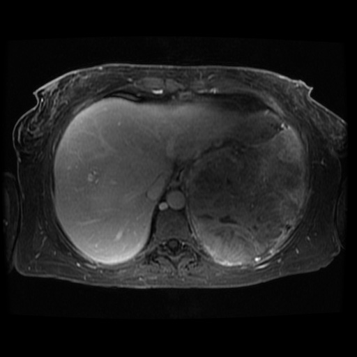 Acinar cell carcinoma of the pancreas (Radiopaedia 75442-86668 D 118).jpg