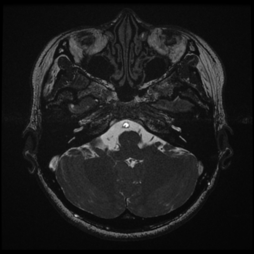 Acoustic neuroma (Radiopaedia 34049-35283 Axial 42).png