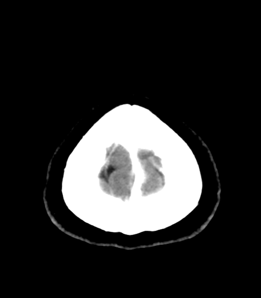 File:Acoustic schwannoma (Radiopaedia 33045-34065 Axial C+ delayed 27).png