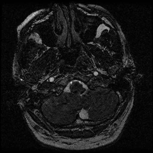 File:Acoustic schwannoma (Radiopaedia 39170-41387 Axial FIESTA 20).png