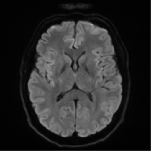 Acoustic schwannoma (Radiopaedia 50846-56358 Axial DWI 43).png