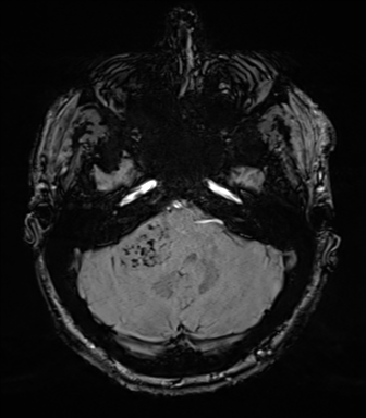 Acoustic schwannoma (Radiopaedia 50846-56358 Axial SWI 22).png