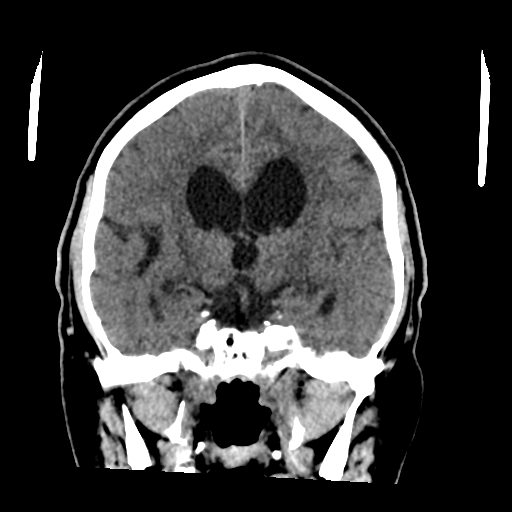 File:Acoustic schwannoma (Radiopaedia 55729-62280 Coronal non-contrast 22).png