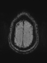 File:Acoustic schwannoma (Radiopaedia 55729-62281 Axial SWI 47).png