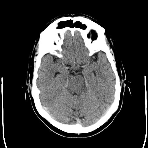 File:Acoustic schwannoma - cystic (Radiopaedia 29487-29980 AXIAL THICK non-contrast 10).jpg