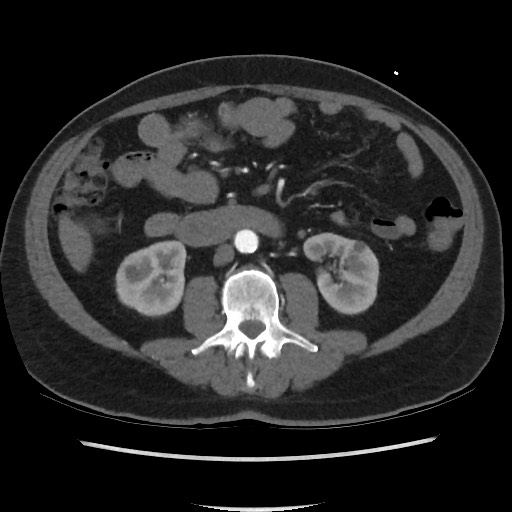 File:Active colonic bleed on CT (Radiopaedia 49765-55025 Axial C+ arterial phase 40).jpg