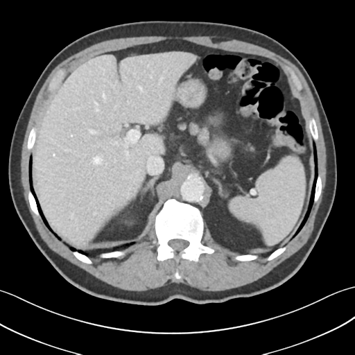 File:Active diverticular hemorrhage (Radiopaedia 39415-41725 Axial C+ portal venous phase 15).png