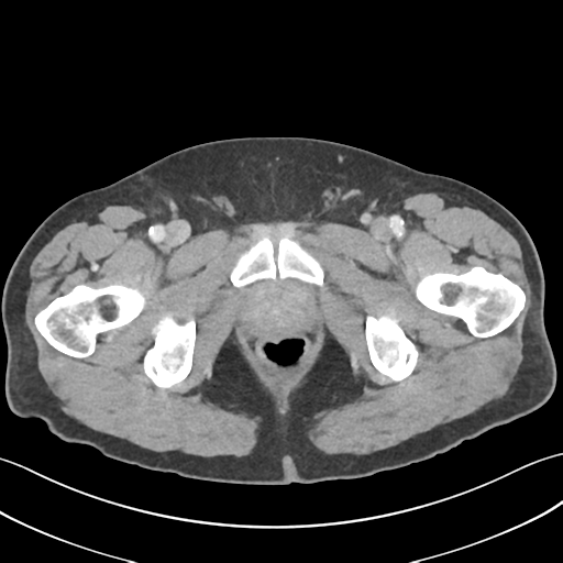 File:Active diverticular hemorrhage (Radiopaedia 39415-41725 Axial C+ portal venous phase 73).png