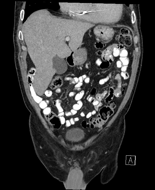 Active lower gastrointestinal bleeding - diverticular (Radiopaedia 61203-69106 Coronal C+ portal venous phase 41).jpg