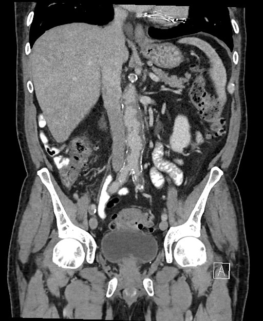 Active lower gastrointestinal bleeding - diverticular (Radiopaedia 61203-69106 Coronal C+ portal venous phase 71).jpg