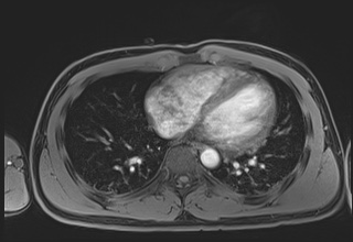 Active right ventricular cardiac sarcoidosis (Radiopaedia 55596-62100 Axial Post contrast Dixon 49).jpg