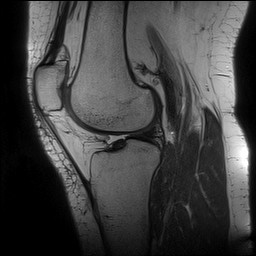 File:Acute-on-chronic transient lateral patellar dislocation with trochlear dysplasia (Radiopaedia 84099-99349 Sagittal PD 94).jpg