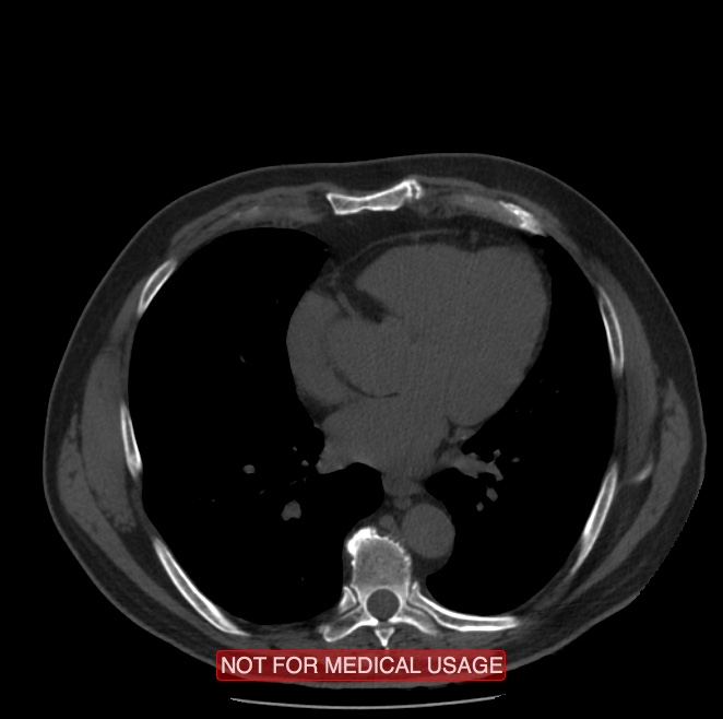 Acute aortic dissection - Stanford type A (Radiopaedia 40661-43285 Axial non-contrast 38).jpg