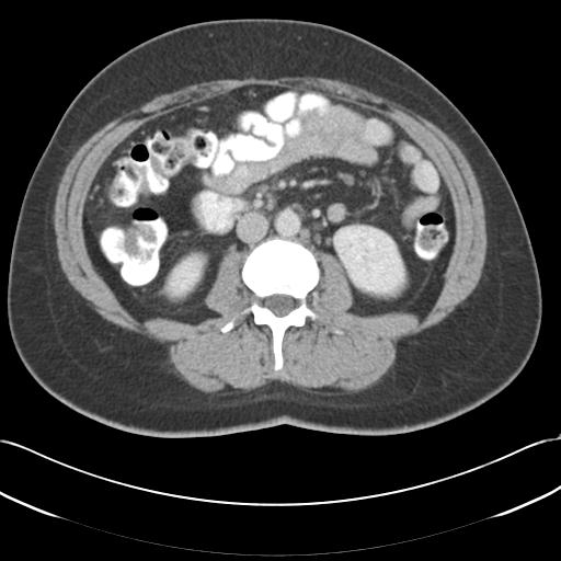 Acute appendicitis (Radiopaedia 30297-30934 Axial C+ portal venous phase 40).jpg