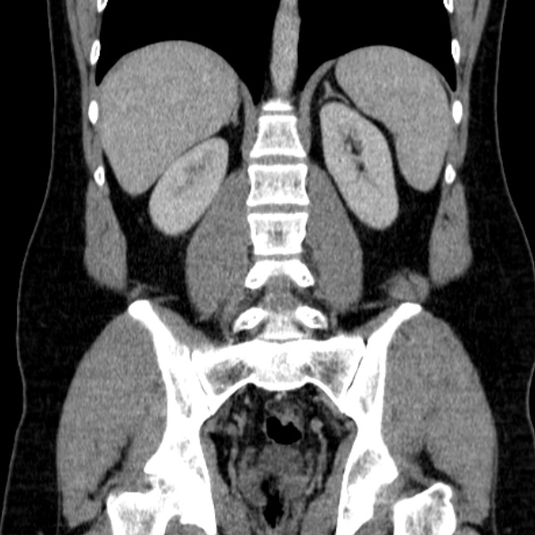 Acute appendicitis (Radiopaedia 38255-40270 Coronal C+ portal venous phase 59).jpg