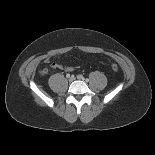 Acute appendicitis (Radiopaedia 48511-53463 Axial C+ portal venous phase 70).jpg